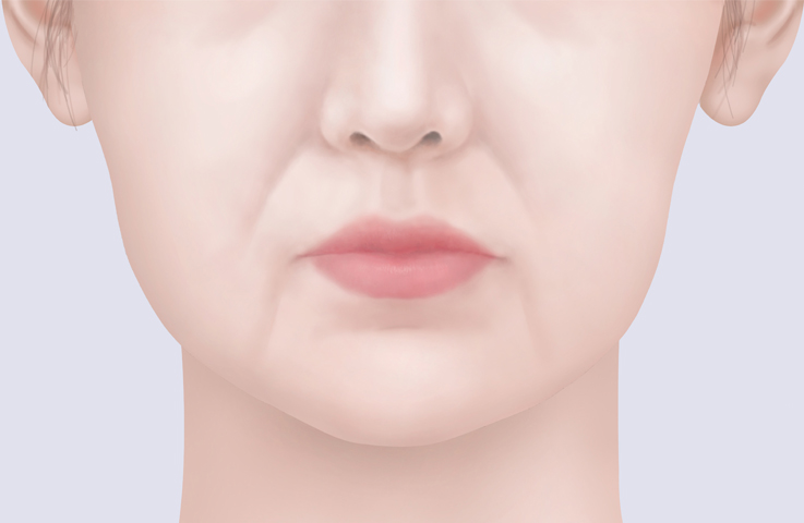볼살이 많은 타입